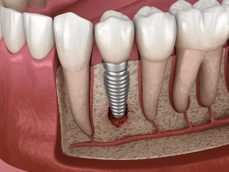 Maxillofacial & Oral Implantology